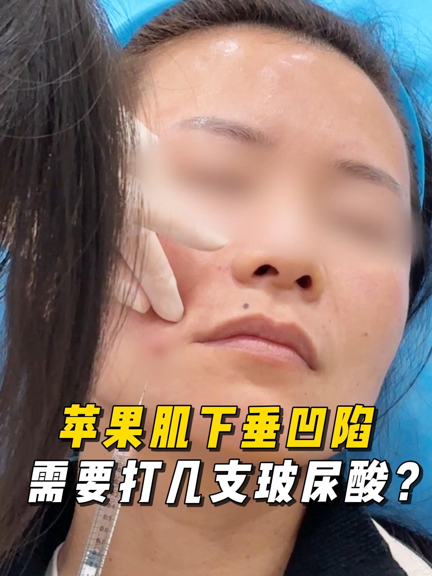 苹果肌肉版(苹果肌肉多怎么瘦下去)-第3张图片-QuickQ官网